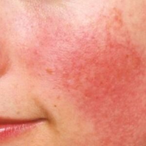 Facial-Redness-and-Rosacea-Misdiagnosis-e1595186945450