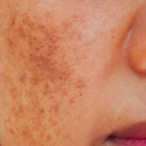 Melasma